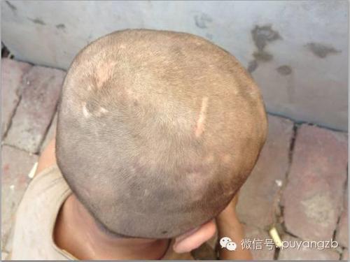 洪波的腦袋上，滿是母親毆打留下的傷痕。