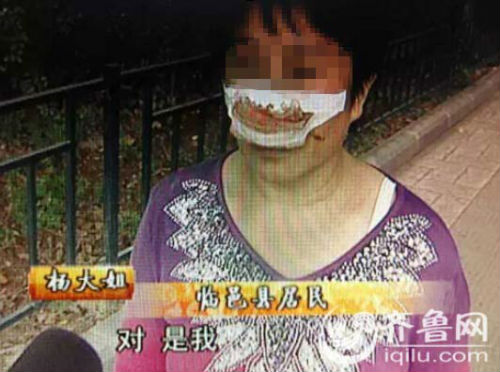 楊大姐自稱來自德州臨邑，鼻子是被丈夫一口咬掉的。（視頻截圖）