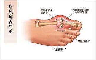 痛風病人吃什么好？ 飲食需合理搭配