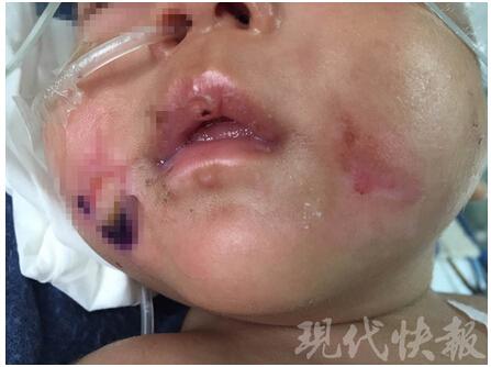三個月大男嬰頭顱出血 身上多處骨折疑遭虐待