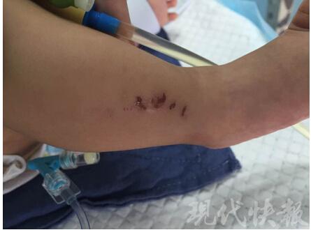 三個月大男嬰頭顱出血 身上多處骨折疑遭虐待