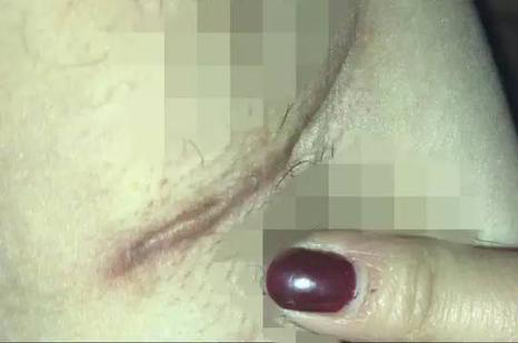 女子花兩萬隆胸傷口腥臭
