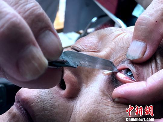 驚險又刺激的“刀鋒洗眼”?！螚?攝