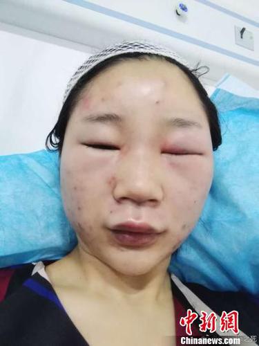圖為當(dāng)事人提供的傷情圖。　網(wǎng)絡(luò)圖攝