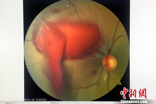 小潘的眼底照相檢查圖，紅色塊為眼底出血血塊?！＄娦?攝