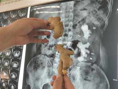 男子體內長出老“生姜” “巨無霸”結石塞滿左腎